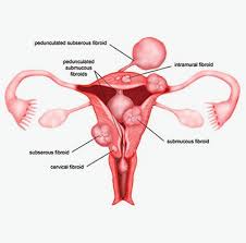 Laparoscopic myomectomy $2500